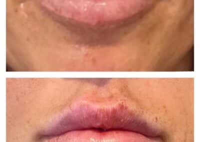 before and after of lip injections