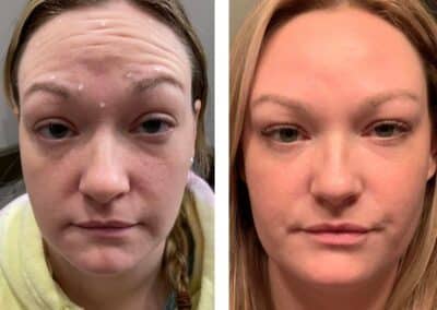before and after of facial injections to remove wrinkles