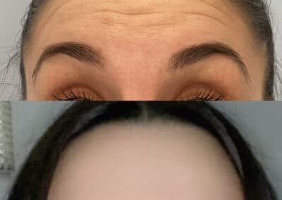 before and after of facial injections to remove wrinkles