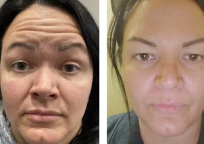 before and after of facial injections to smooth wrinkles