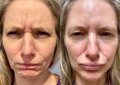 before and after facial injection to smooth wrinkles