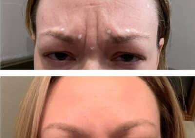 before and after to smooth wrinkles