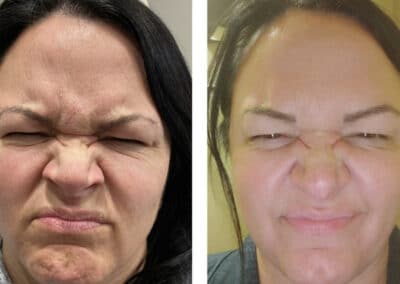 before and after of facial injections